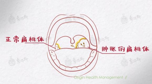 被扁桃腺疾病毁掉的孩子