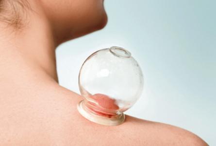 拔罐后的黑印意味着什么?涨知识的科普,快来瞧瞧