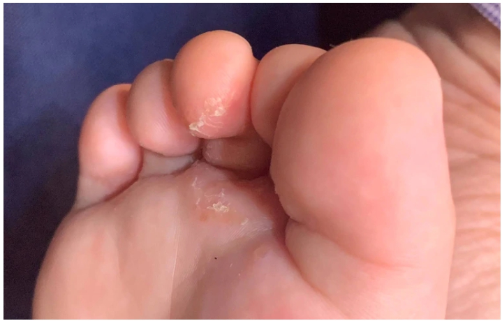 爷爷家中光脚,留满地皮屑,2岁孙被传染脚气!