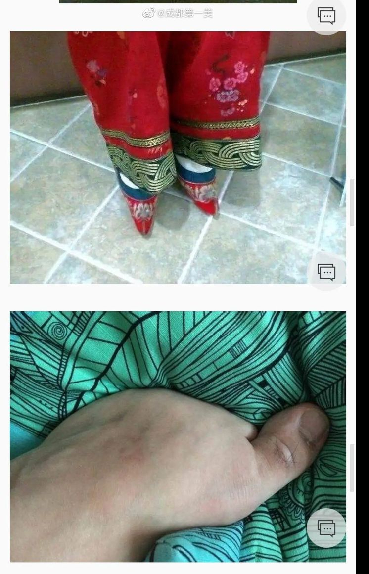 封建余孽的复活:2021年了竟然还有人缠足,还说这是医疗美容!