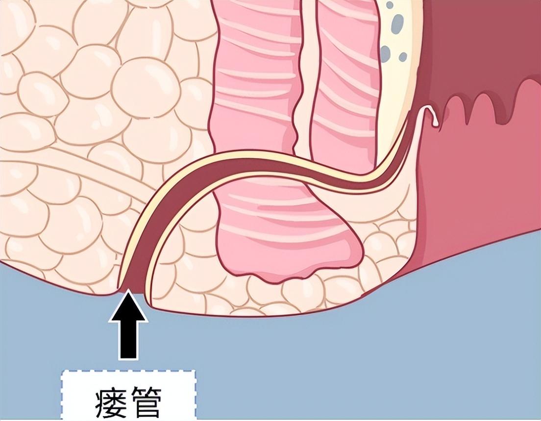 肛窦炎图片卡通图图片