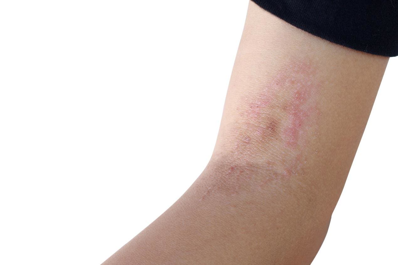 败血症来临,身上会发出4个信号!提醒:注意4件事,远离血液病