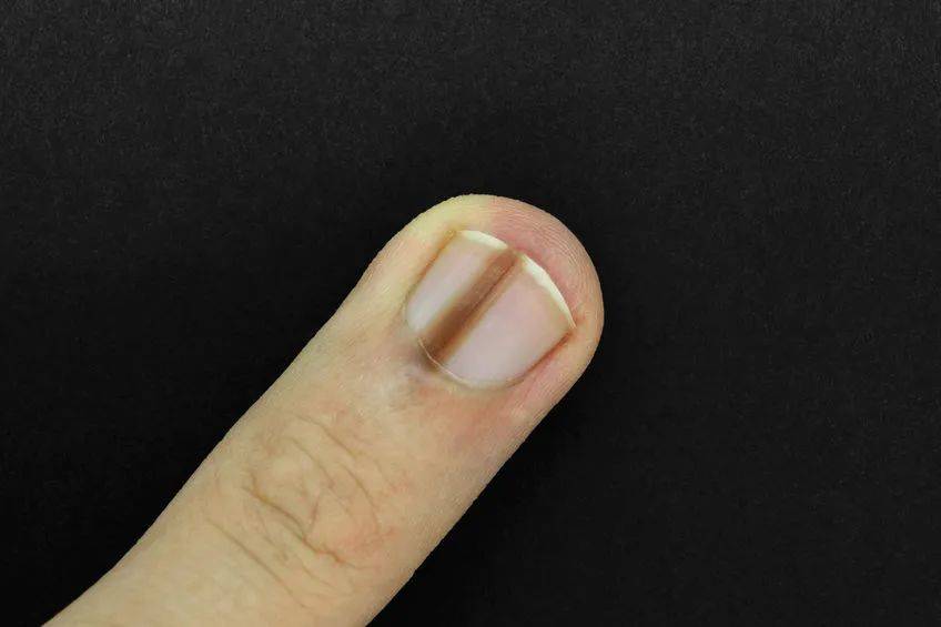 指甲上有竖纹,到底是怎么回事?是肝不好吗?看完涨知识了
