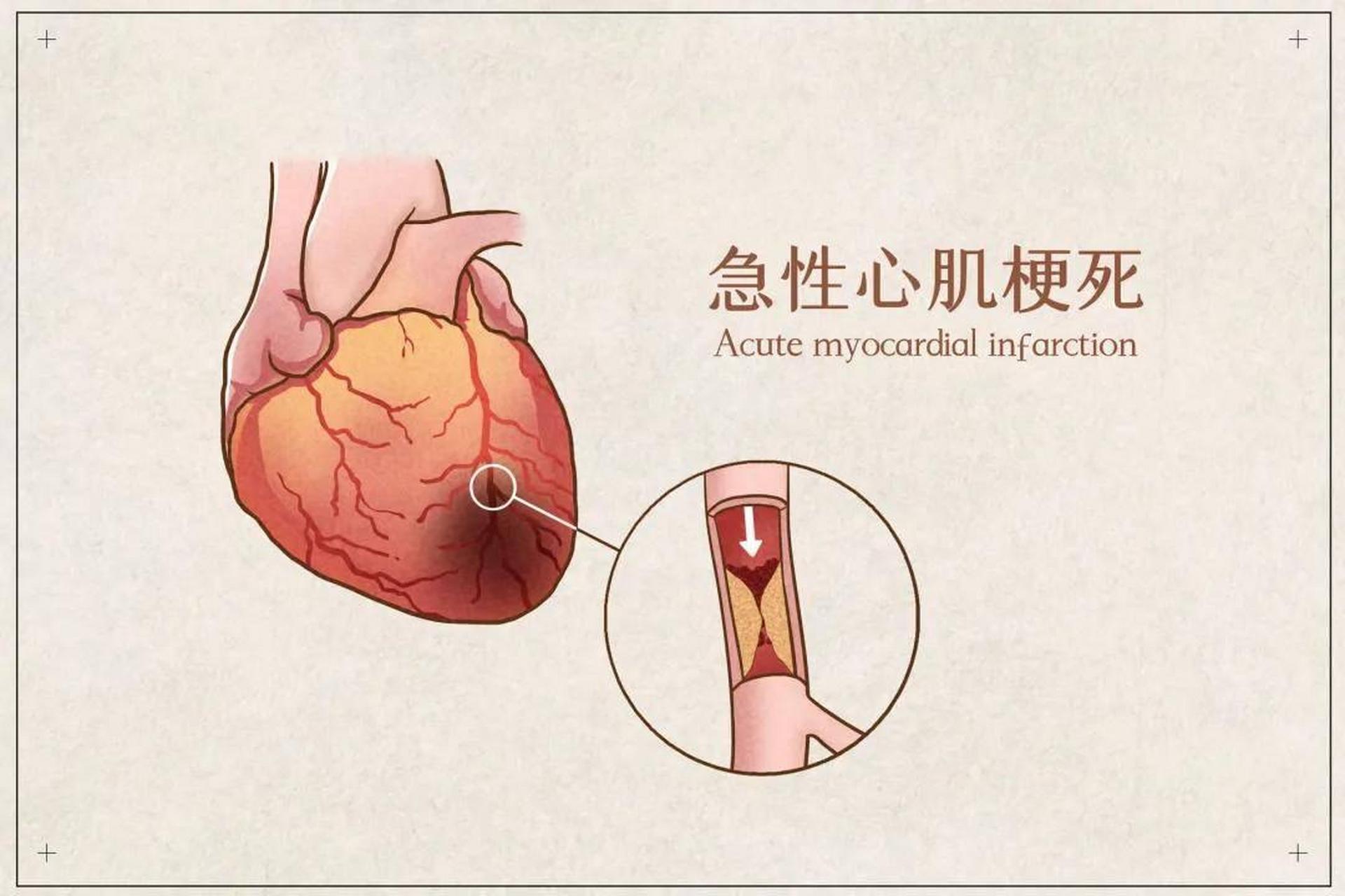 突发心肌梗死,一定要记住4个"千万不能做"和"一定要做"!