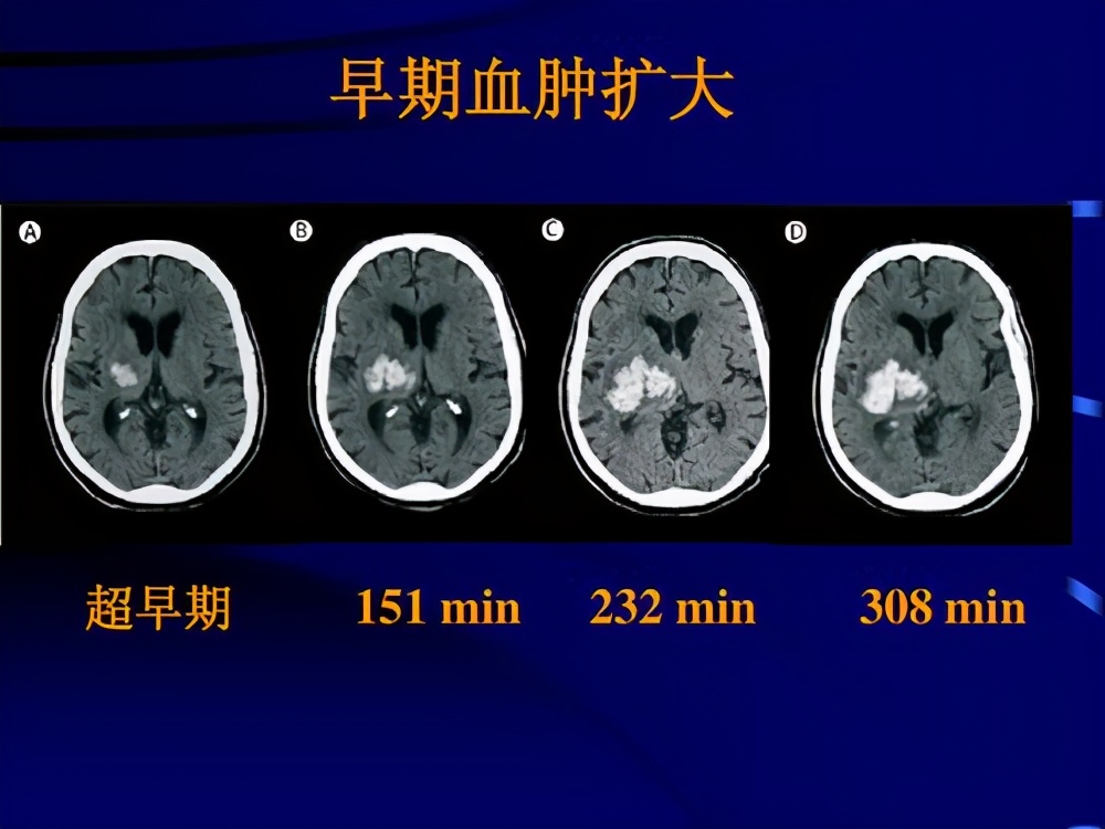 自發性蛛網膜下腔出血,是一種急性腦血管病,病人整體預後較差