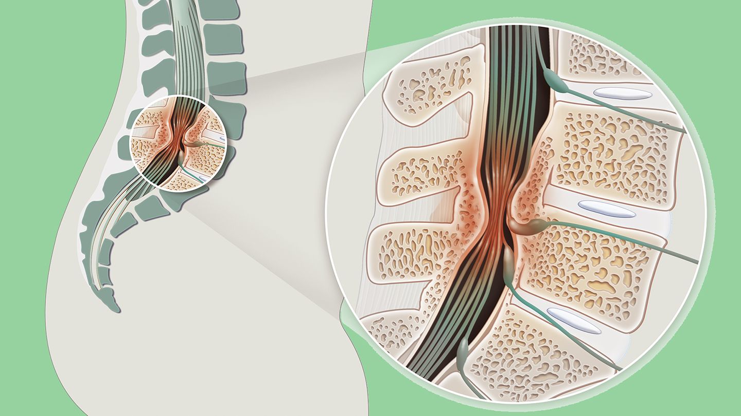 椎管狭窄spinal stenosis怎么办?