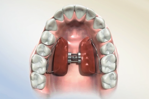 前牙扩弓则扩展牙齿长度,适用于嘴不是特别突的.