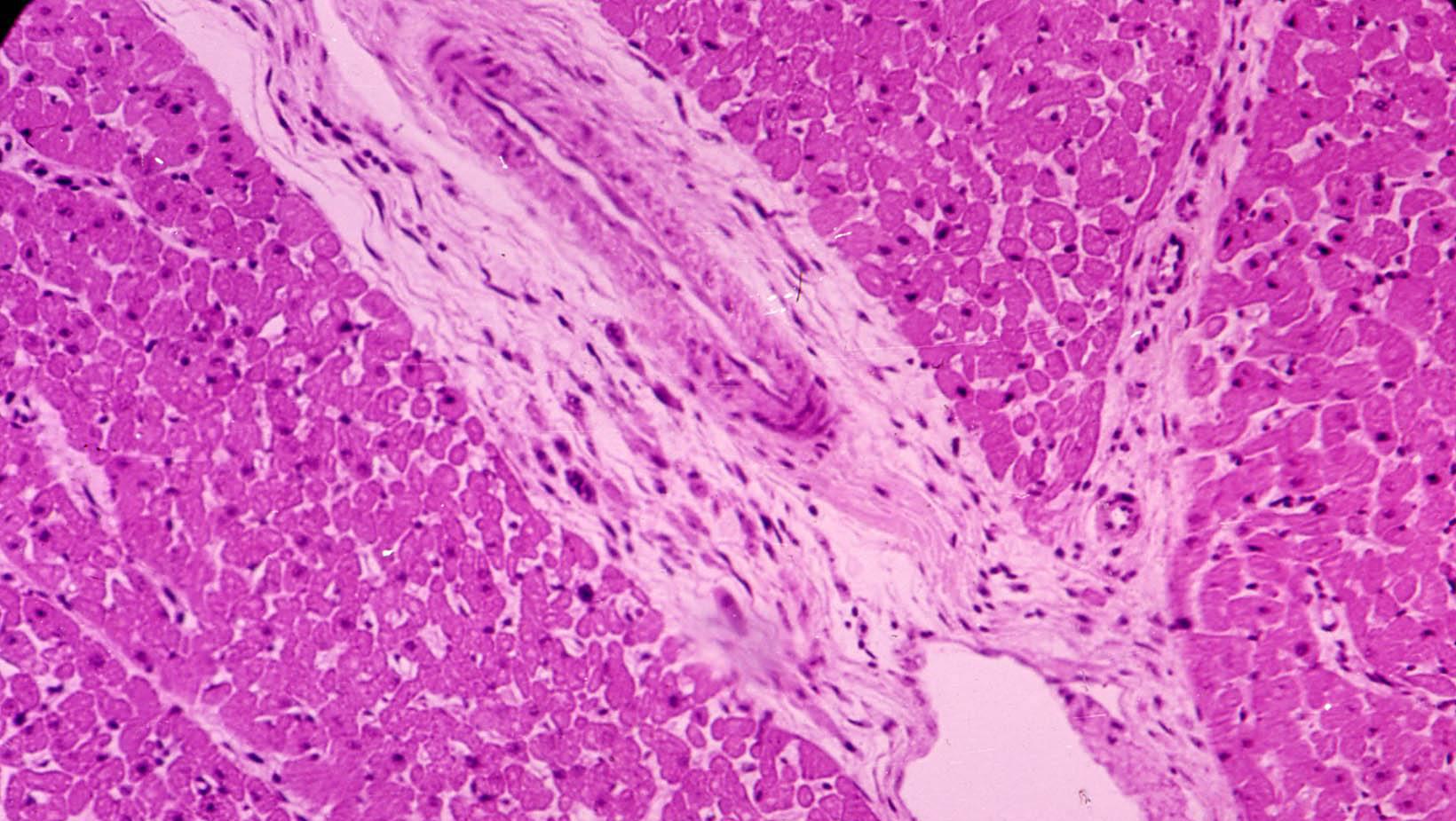 多发性肌炎和皮肌炎伴发的精神障碍,病因不明,心理疗法很重要