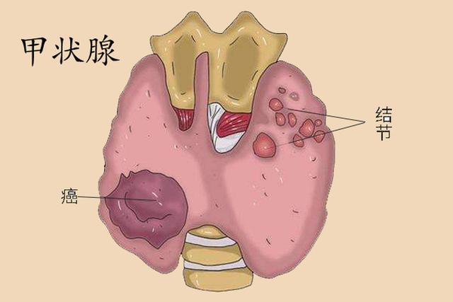 甲状腺癌是拖出来的吗?医生:若身体出现6种变化,建议检查