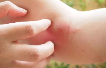 蚊子包越大,毒性就越大?