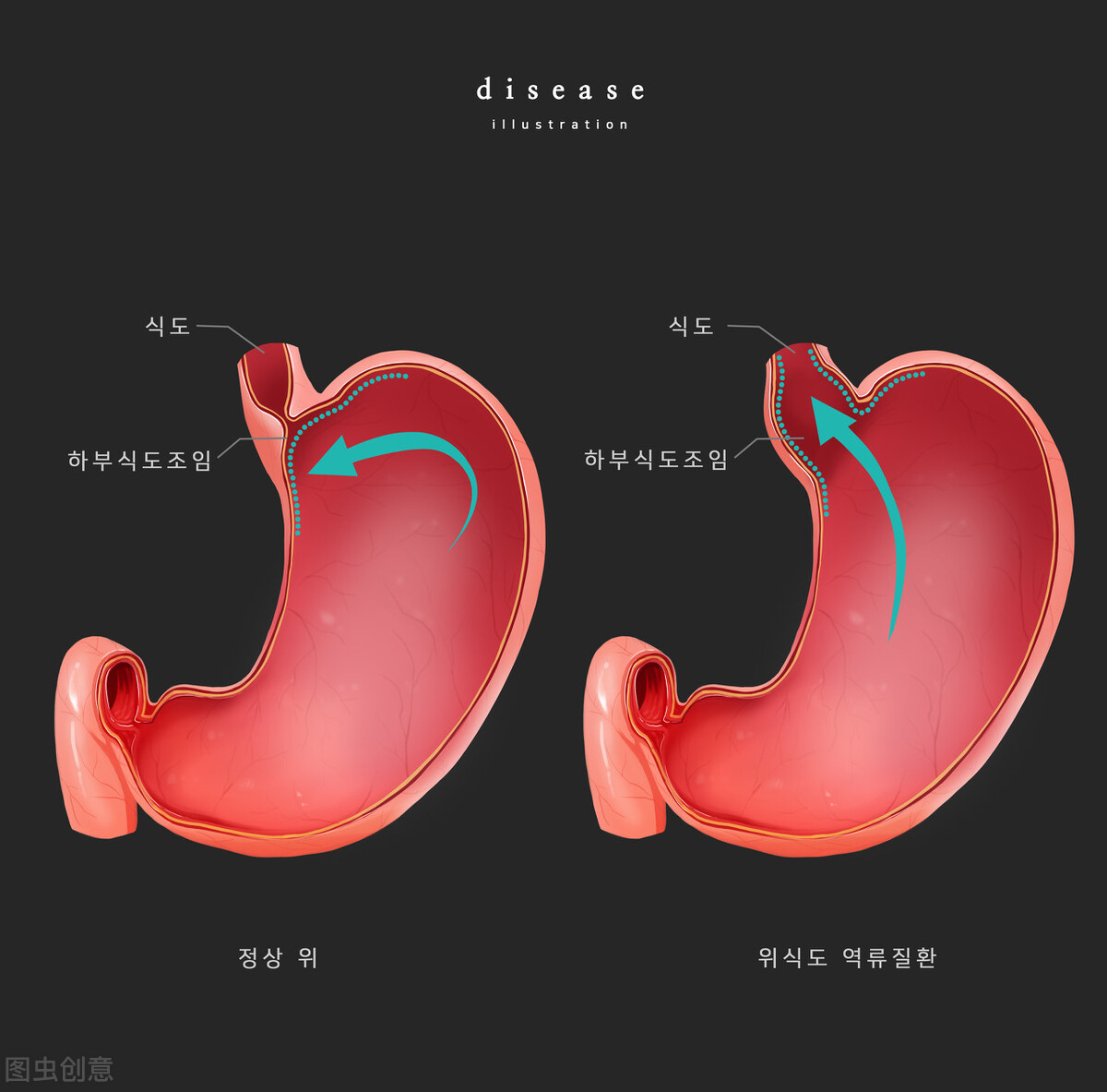 經常反酸,燒心,可能是胃食管反流了,別忽視這6種症狀