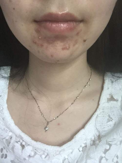 35岁了,脸上的痘痘反反复复的长,怎么回事百科在线 35岁了,脸上的痘痘反反复复的长,怎么回事百科在线