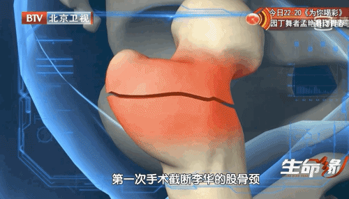 他上身折叠180度,身高不足90cm,母亲求医28年,身体敲断4次变直