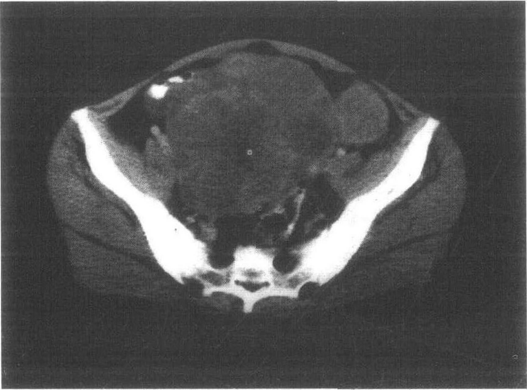 关于盆腔癌的病理学特征和分子机制的了解  盆腔癌是一类发生在女性