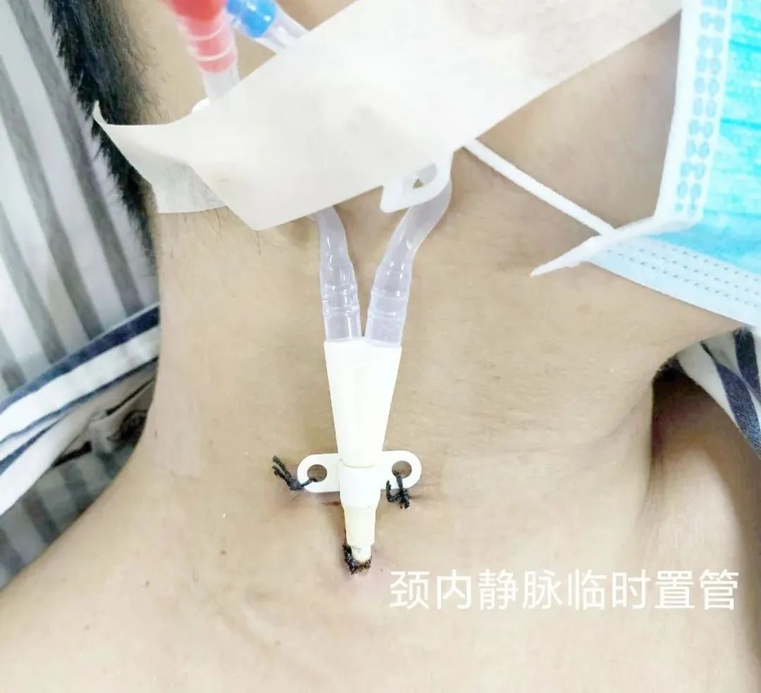 「积医科普」血管通路小组在行动——保卫血液透析患者"生命线"(一)