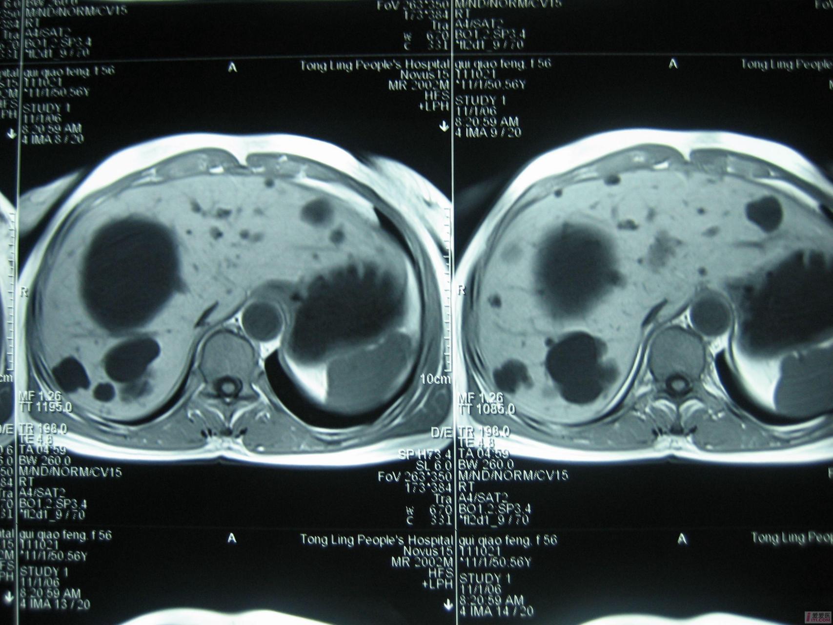干荷叶,可不单单能减肥,它还能给肝囊肿"瘦身",从大变小?