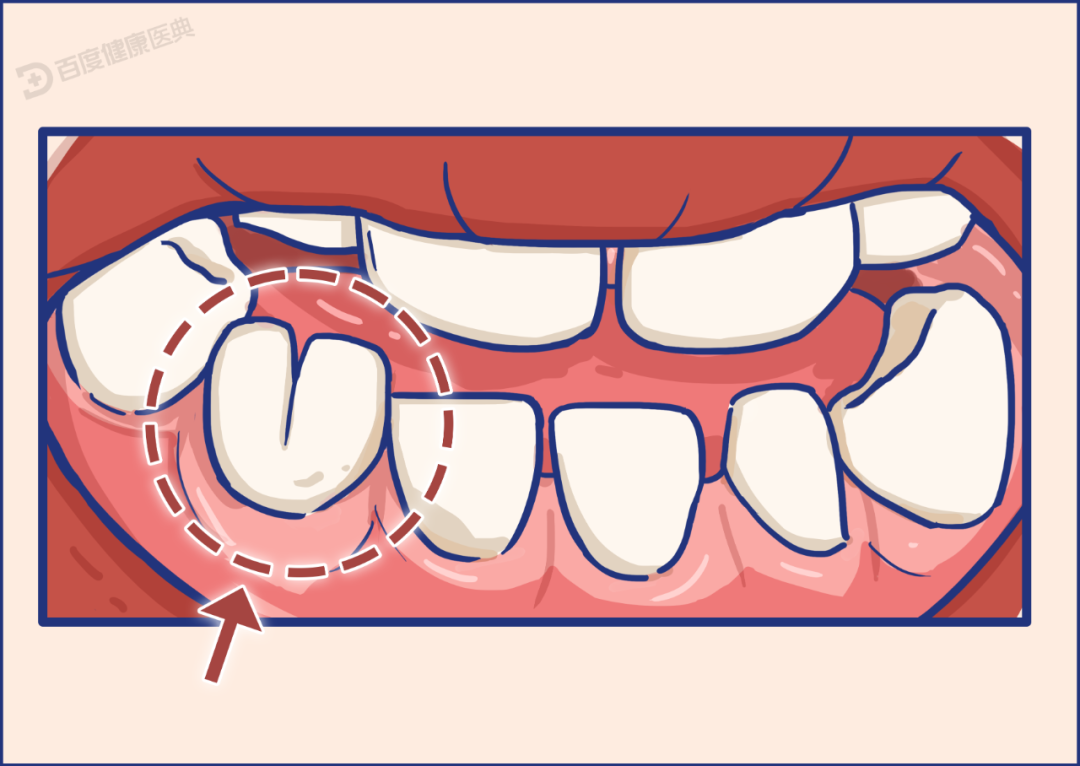 婴儿融合牙图片