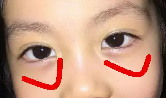 孩子眼睛出现几个迹象,往往是脾胃双虚的前兆,一出现就该警惕了