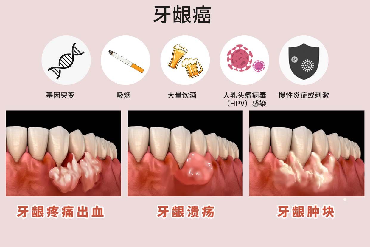 菜花状牙龈癌最开始什么样