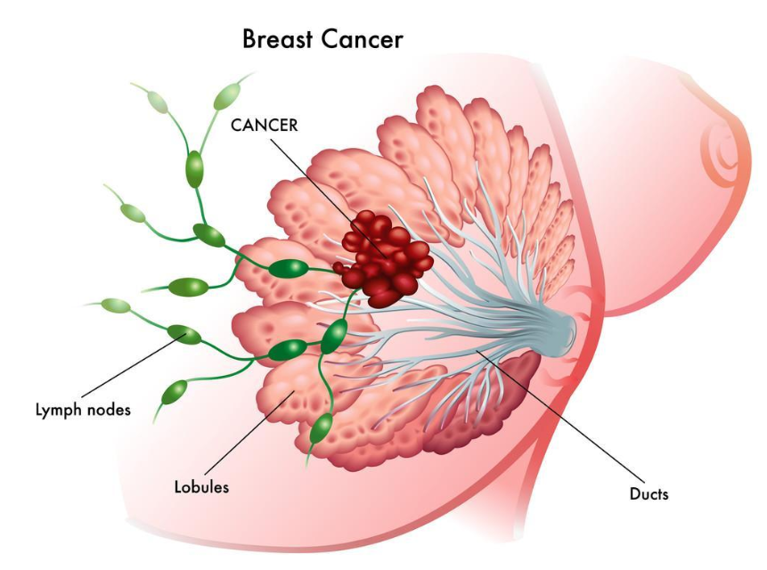 炎性乳腺癌症状图片