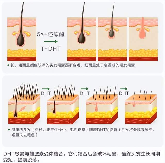 头皮油腻,痒!雄激素性脱发,怎么治?