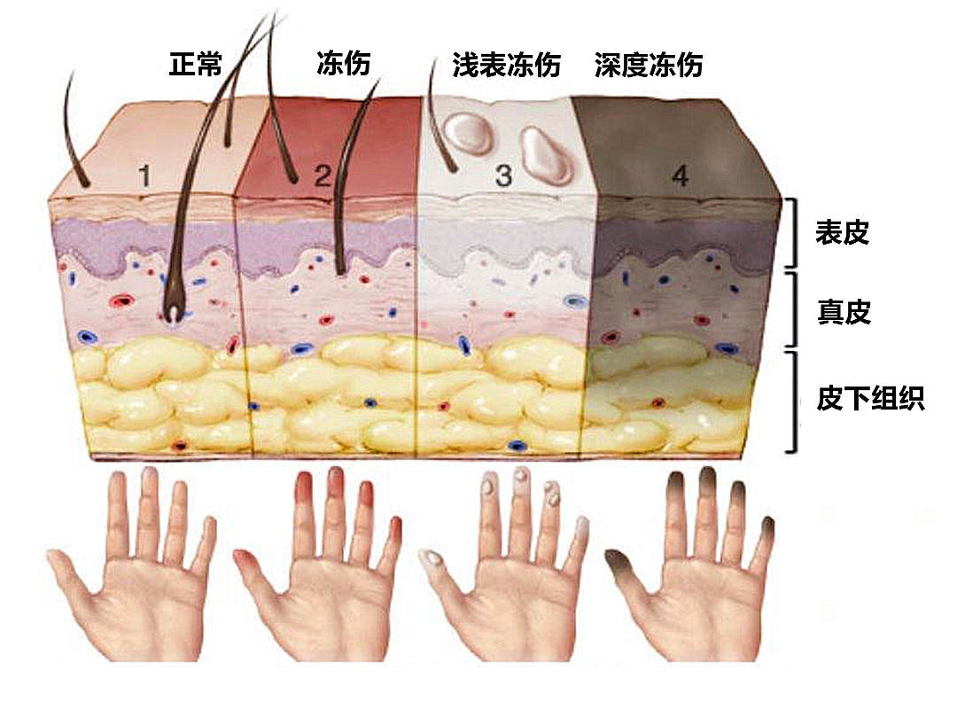 冻疮愈合的过程图片