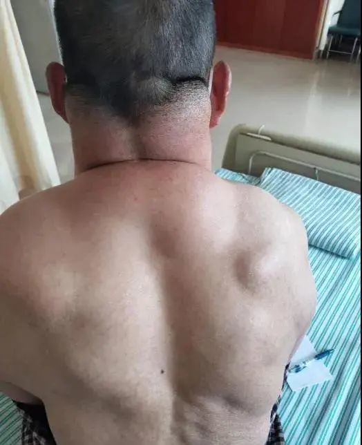 热点|男子把酒当茶喝，每天2斤半！结果脖子比头还大，切下七八斤脂肪