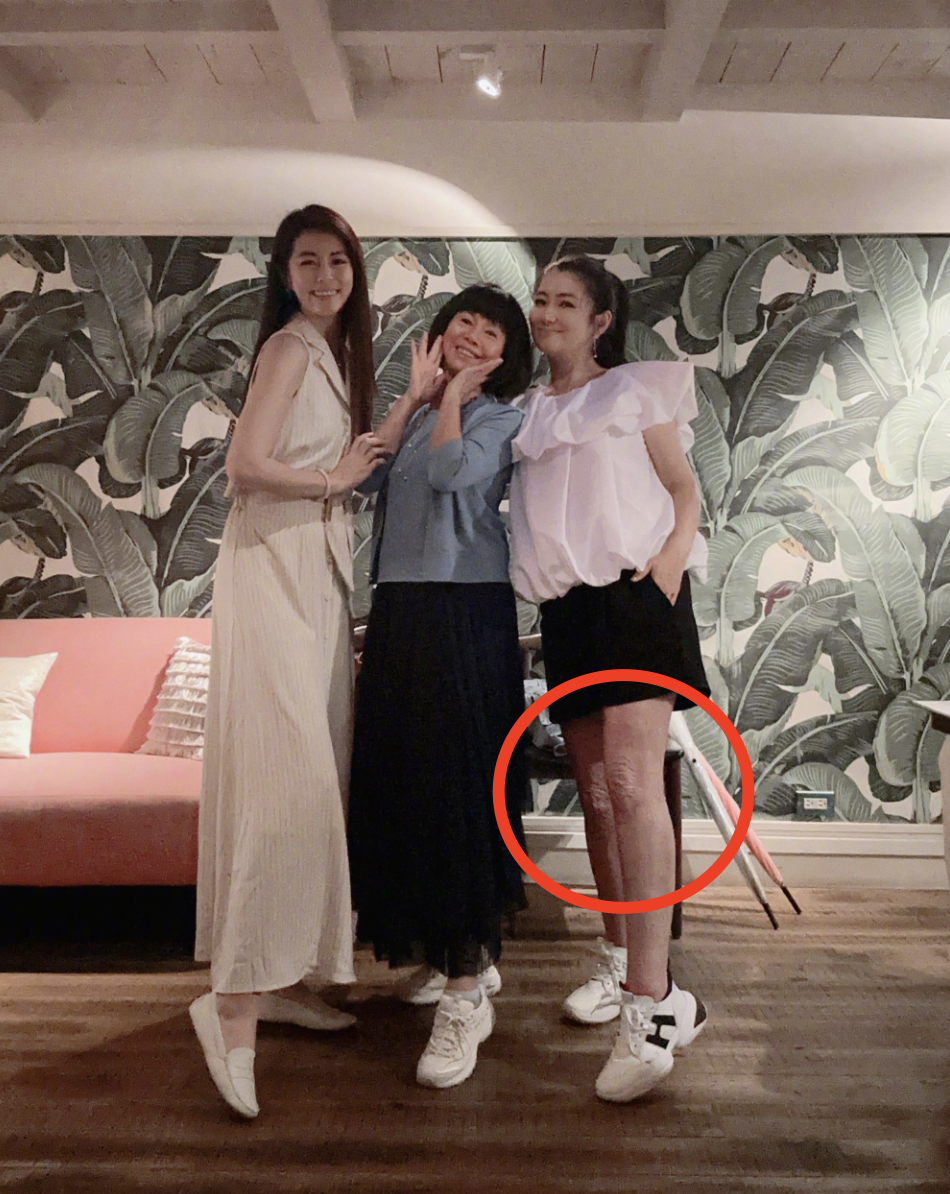 任家萱过母亲节罕见穿短裤,双腿烧伤疤痕暴露无遗,粉丝直呼心疼