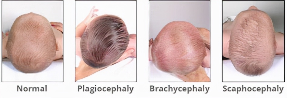 宝宝头型不好看?学会这几招轻松改善宝宝头型问题