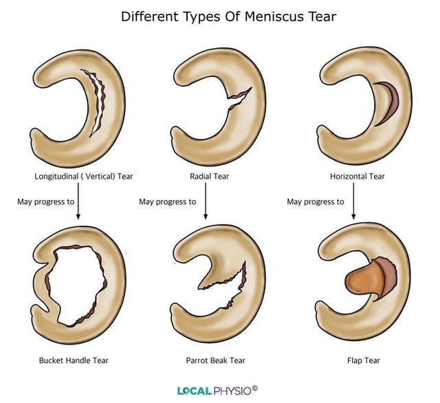 meniscustear图片