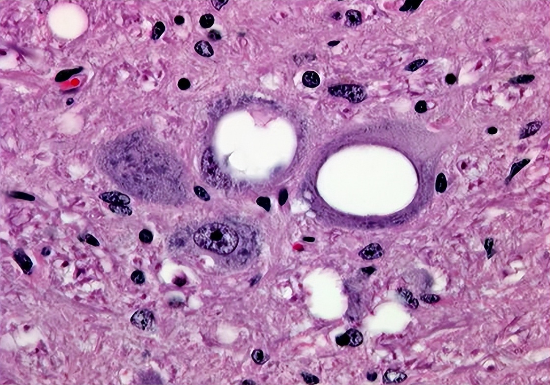 食人部落爆发库鲁病,患者在疯笑中死去,朊病毒到底有多可怕?
