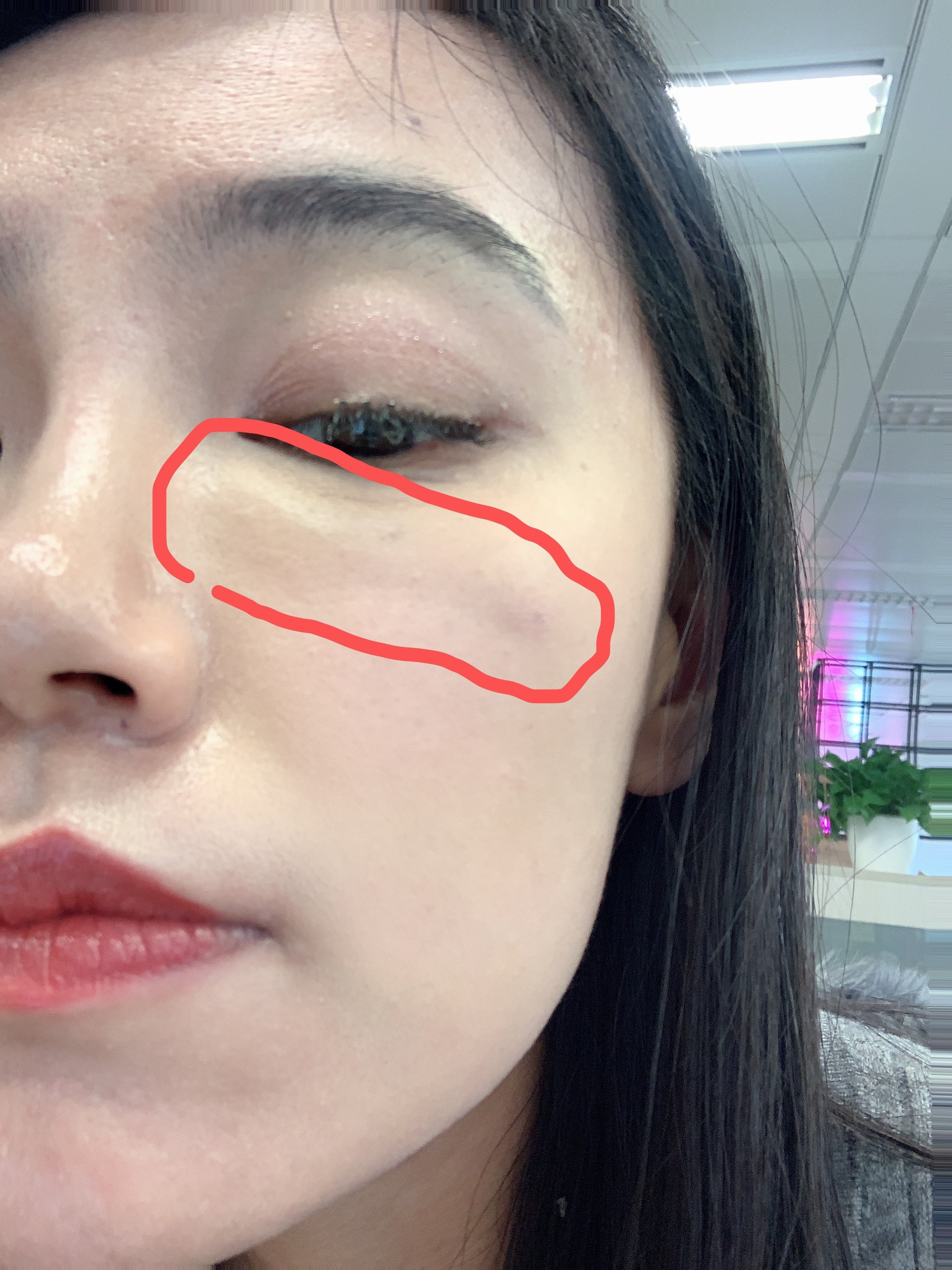 磨皮滤镜无法消除的泪沟,如何挽救?玻尿酸填充需注意什么?