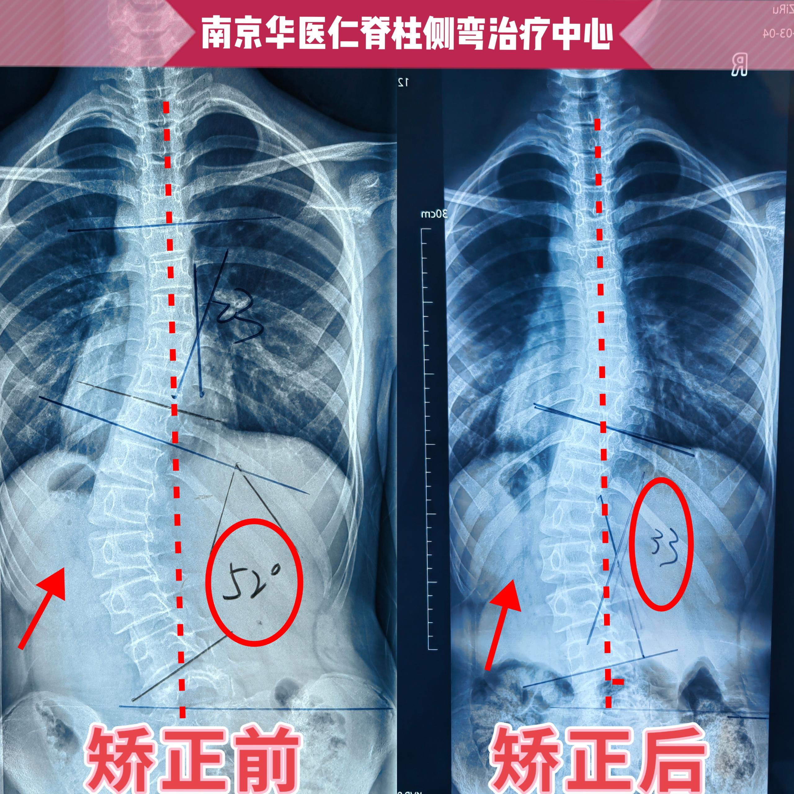 南京康玉山医生——脊柱侧弯矫正案例