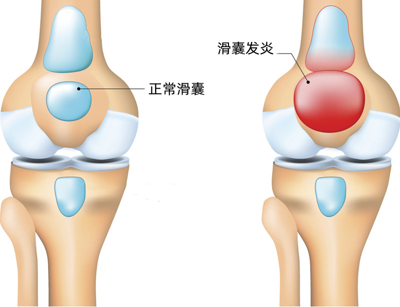 膝关节的滑膜囊解剖图图片