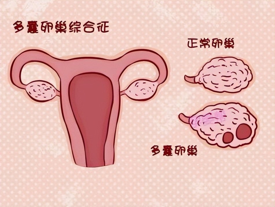 美妙!多囊不排卵卵子去哪了"信誉至上"-第1张图片-蒲城博客