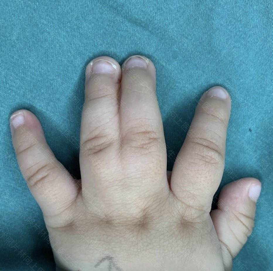 先天性并指多指畸形,多发于单侧手指,拇指和小指常见