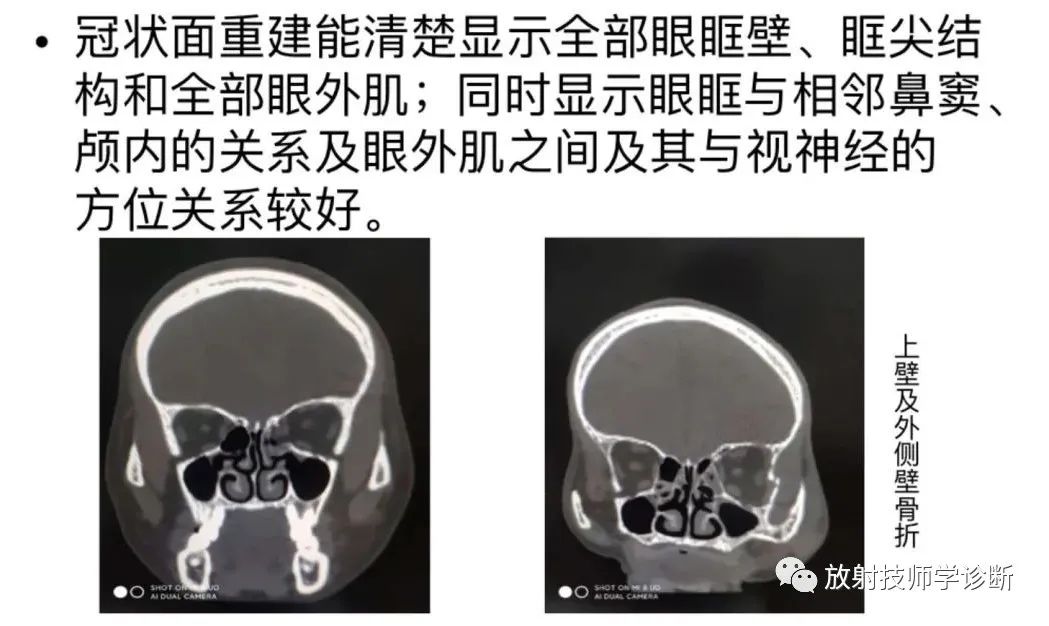 眼肌ct解剖图片