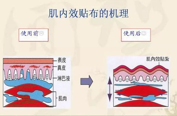 脑卒中患者的彩色战袍