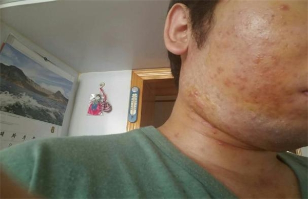 皮肤有炎症怎么办 baijiahao.baidu.com