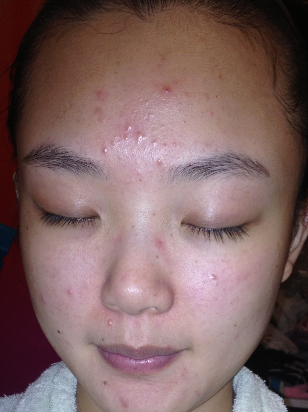 粉刺是常见的皮肤问题,为什么总长粉刺?该怎么做才能去除它们?