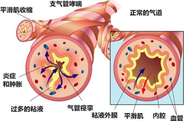 明显的气道重塑,导致气流受限的可逆性明显减小,临床很难与copd相鉴别