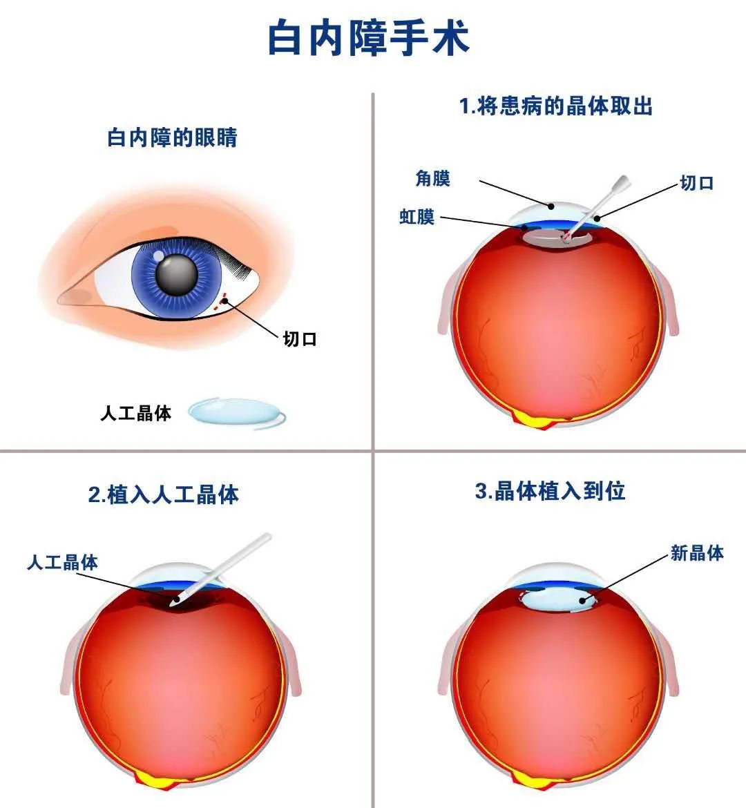 解读医学验光配镜的新趋势与机遇