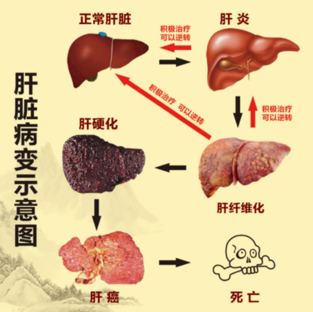 肝硬化发病机制图图片