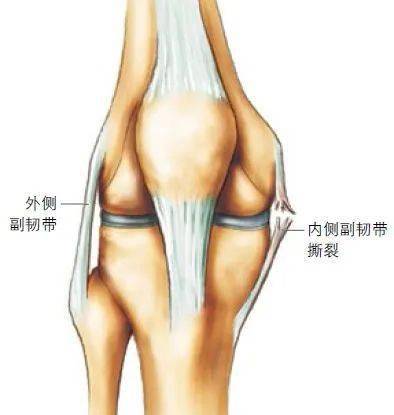 外侧副韧带疼痛?别让它影响你的运动和生活!