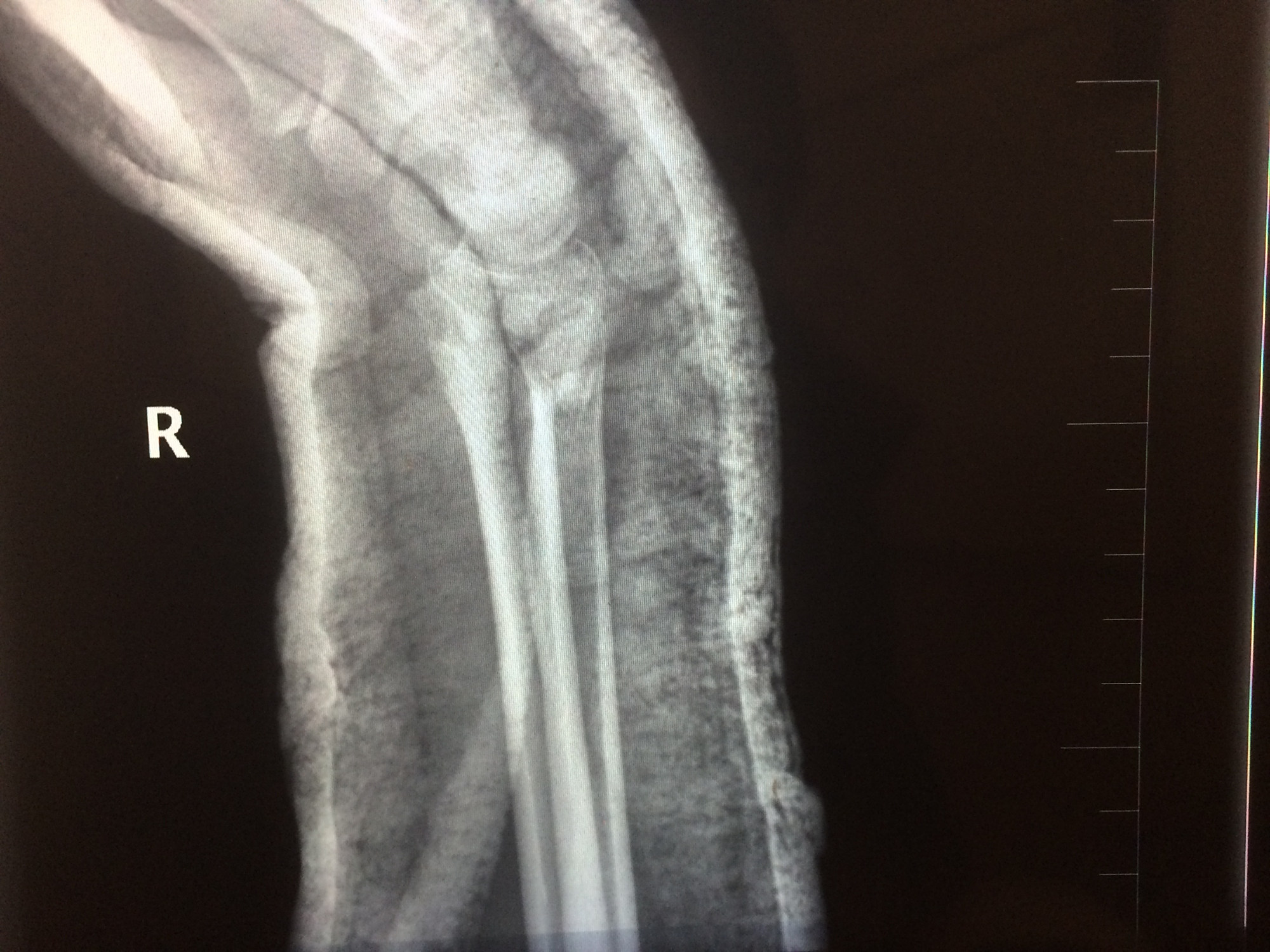 人骨折了,是一种什么体验,讲述我的真实骨折体验
