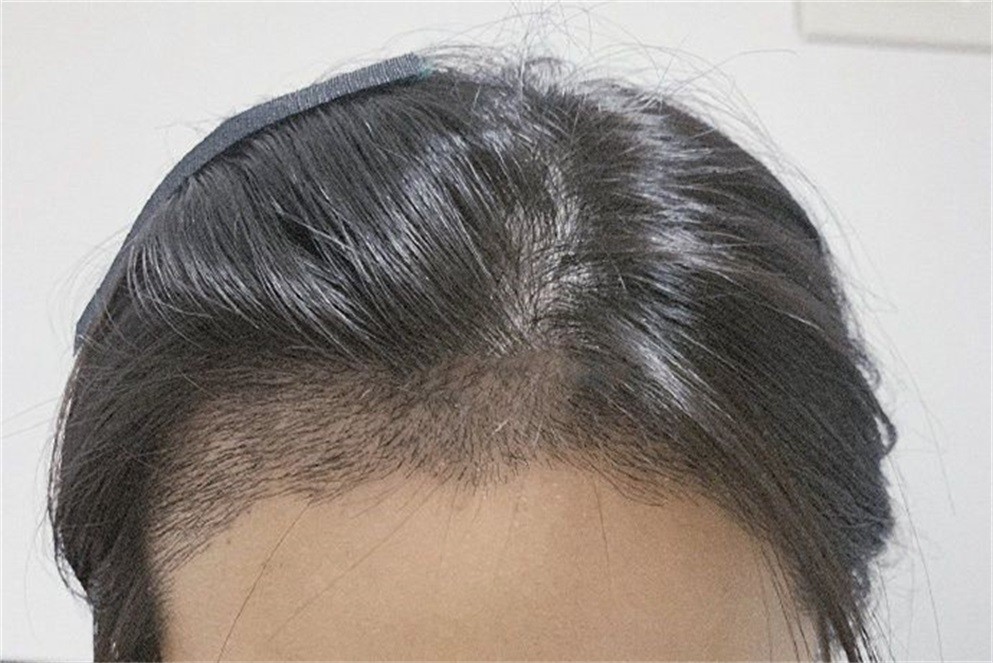 植发之后斑秃怎么回事(植发后斑秃属于医疗事故吗)