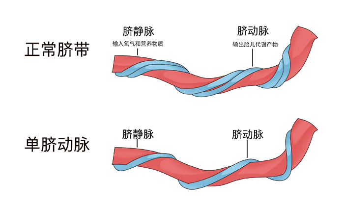 b超检查出胎儿单脐动脉,要不要紧?