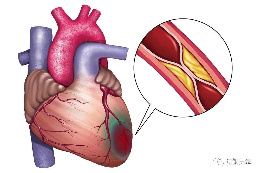 刘建钢教授:支架搭桥前先试下"臭氧"治疗