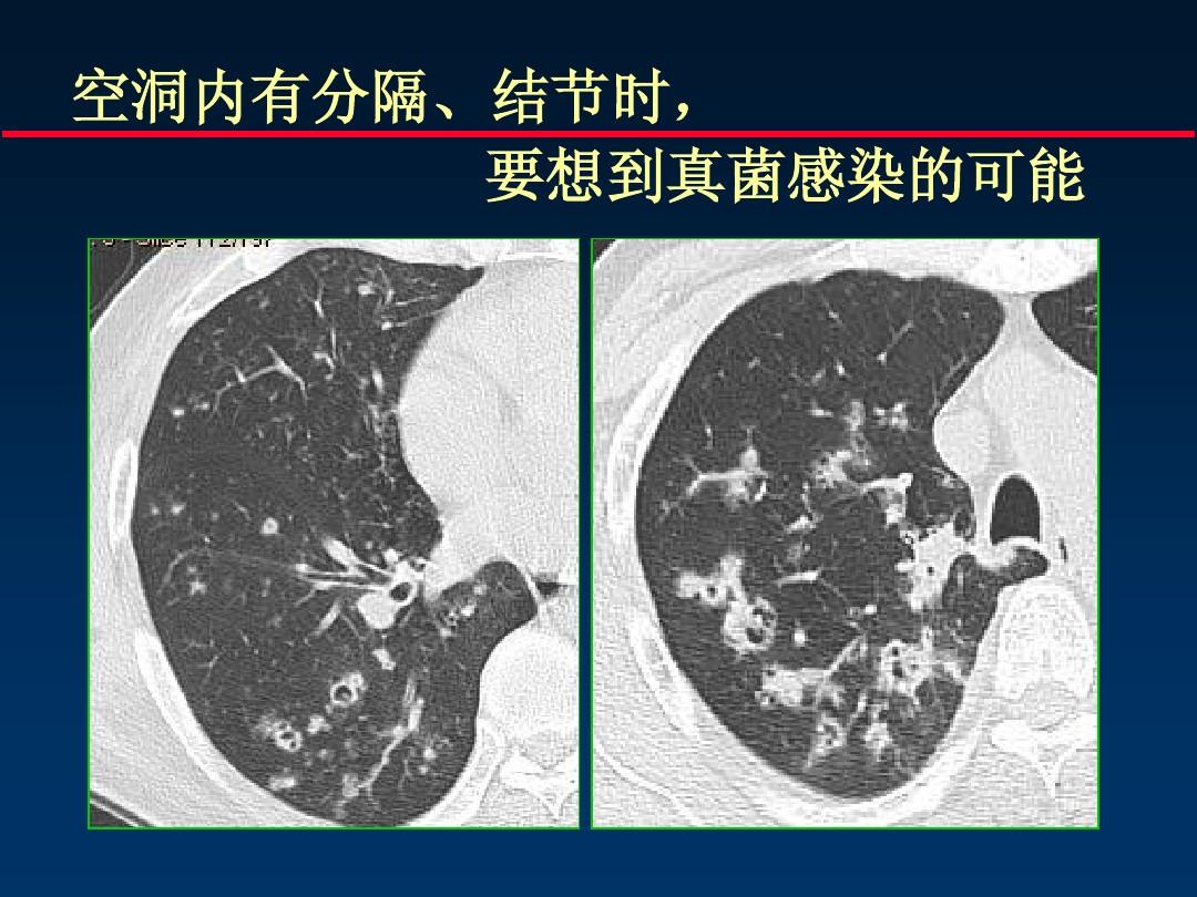 肺真菌病分为三种,治疗方法有抗生素治疗,两性霉菌b联合治疗