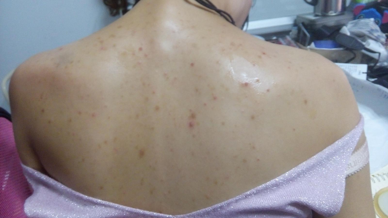 贝赫切特综合征的患者,可能跟遗传有关,并发症明显,早就医